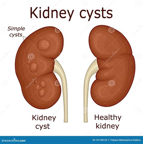 Illustration d'un rein sain avec des kystes