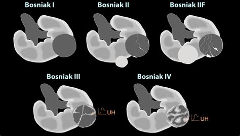 Diagramme illustrant la classification de Bosniak pour les kystes rénaux
