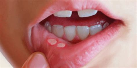 Image montrant différents types d'aphtes buccaux