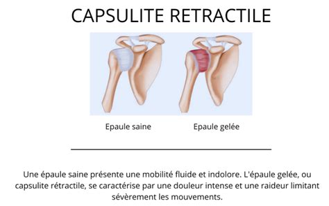Schéma illustrant les trois phases de la capsulite rétractile