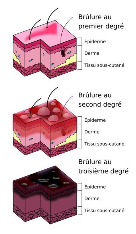 Diagramme des degrés de brûlure