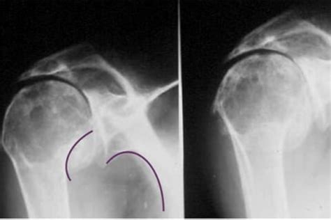 Comparaison entre réduction centrée et excentrée