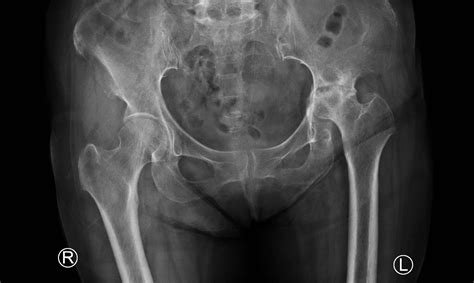 Radiographie d'une hanche montrant des corps étrangers intra-articulaires