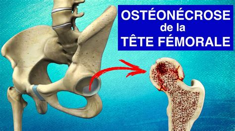 Schéma de la tête fémorale montrant une zone de nécrose