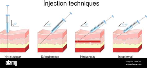 Illustration d'une seringue d'injection de scellant chimique dans un trou de perçage
