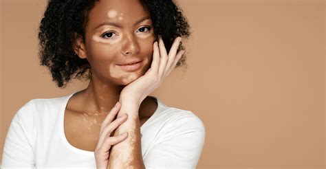 Image illustrant les taches de vitiligo sur la peau