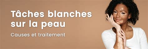 Infographie montrant les différentes causes de taches blanches sur la peau