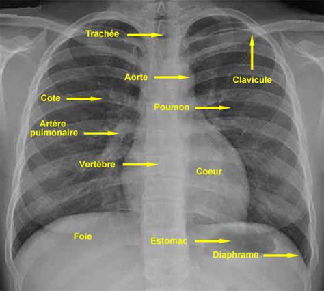 Radiographie thoracique de face normale