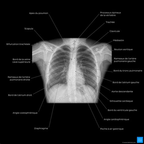 Radiographie thoracique montrant une dilatation de l'artère pulmonaire