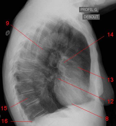 Segmentation du médiastin sur une radiographie de thorax de profil