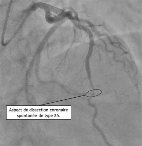 Exemple de coronarographie montrant une sténose coronaire