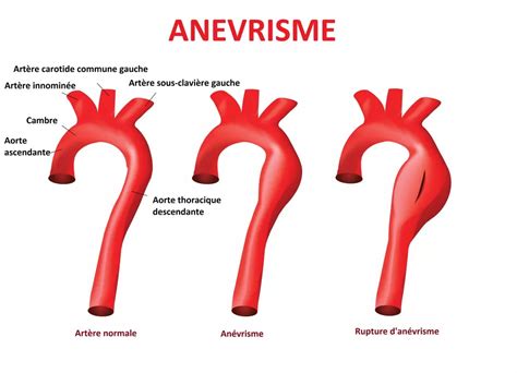 Représentation d'un anévrisme aortique