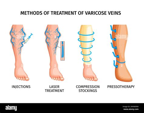 Comparaison des techniques de traitement des varices