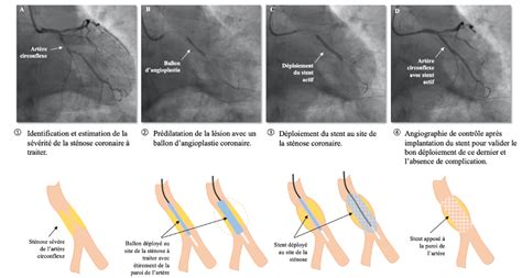 Diagramme illustrant une angioplastie avec pose de stent